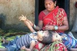 Odisha’s conjoined twins: Kalia dies, Jaga is fine